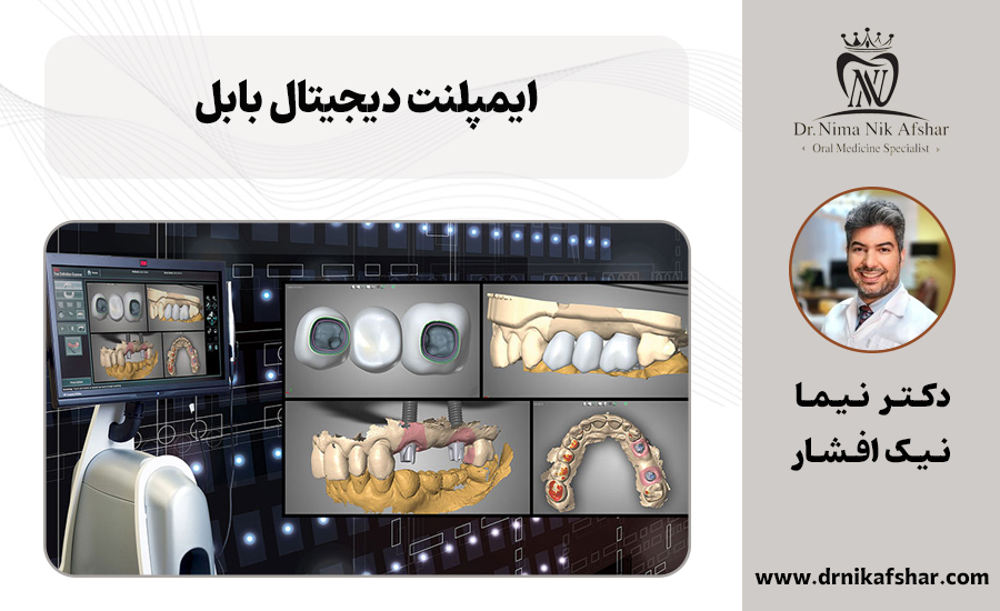 ایمپلنت دیجیتال بابل