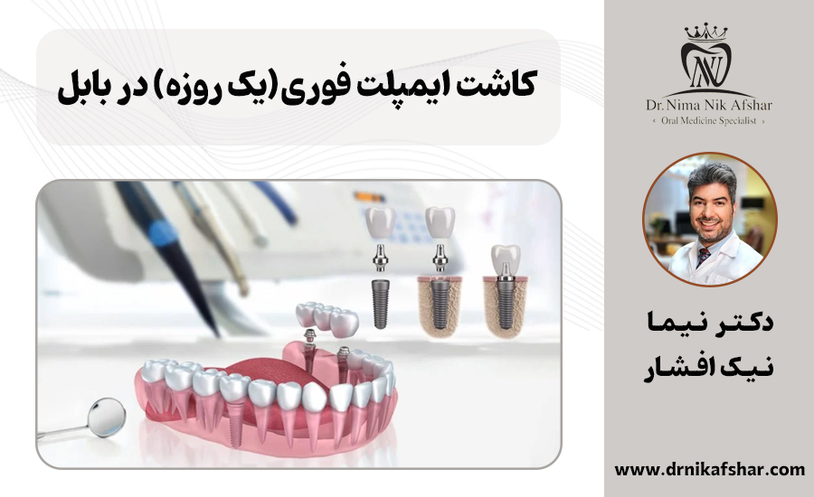 کاشت ایمپلنت فوری در بابل