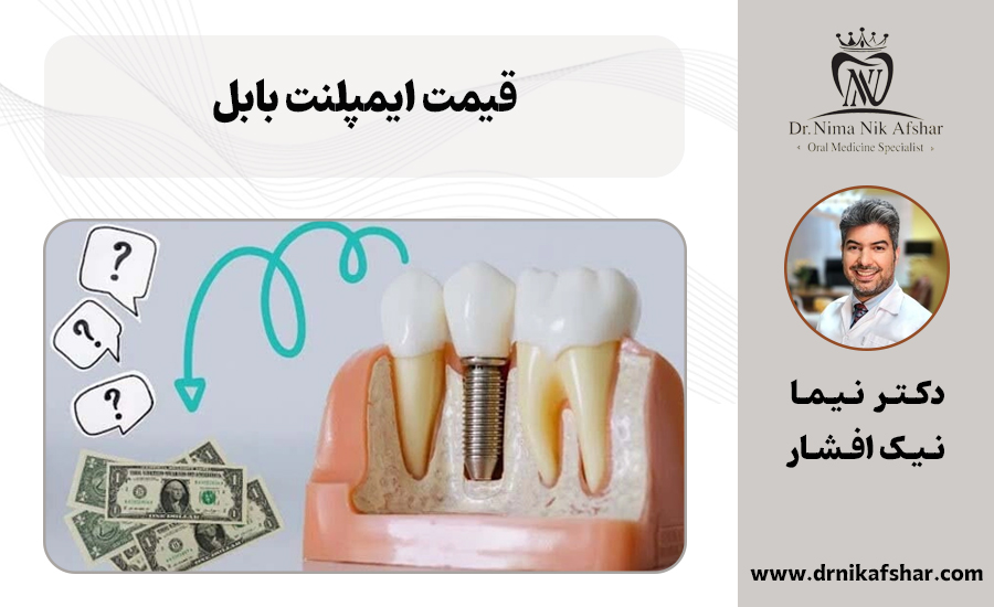 قیمت ایمپلنت بابل