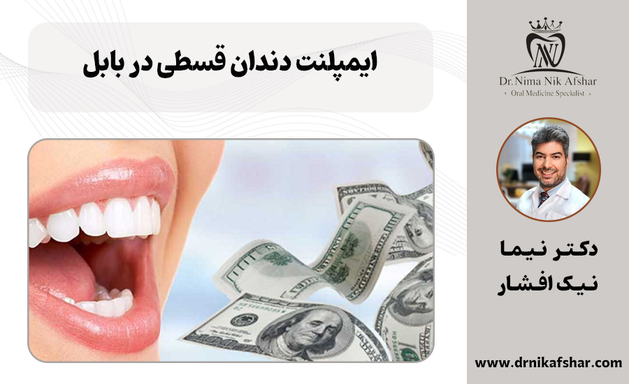ایمپلنت دندان قسطی در بابل