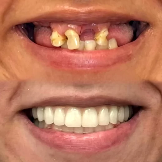 Photo-of-dental-implant-520x520