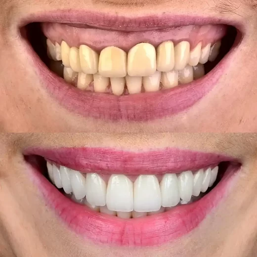 Photo-of-dental-veneer-1-520x520