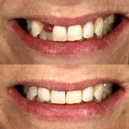 Photo-of-dental-veneer-2-520x520