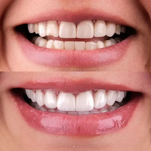 Photo-of-dental-veneer-520x520