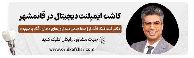 کاشت ایمپلنت دیجیتال در قائمشهر