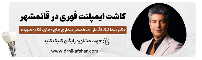 کاشت ایمپلنت فوری دندان در قائم شهر