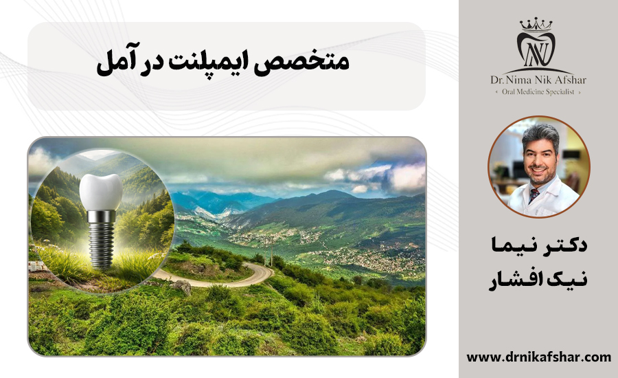 متخصص ایمپلنت دندان در آمل