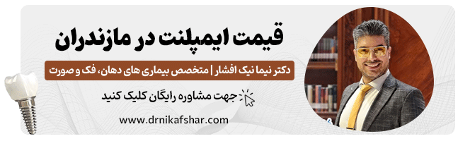 مشاهده قیمت ایمپلنت در استان مازندران