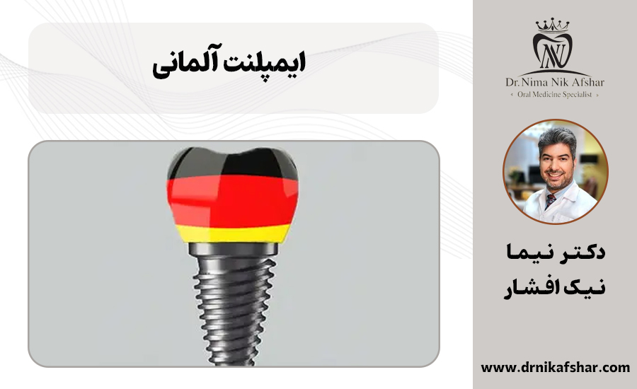 ویژگی انواع ایمپلنت آلمانی + قیمت