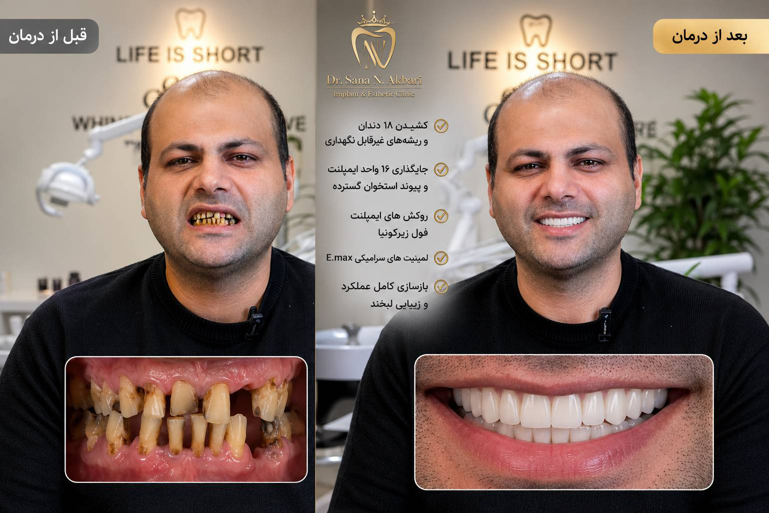 بازسازی کامل دهان در بیمار مبتلا به فوبیای شدید دندان‌پزشکی با رویکرد دیجیتال
