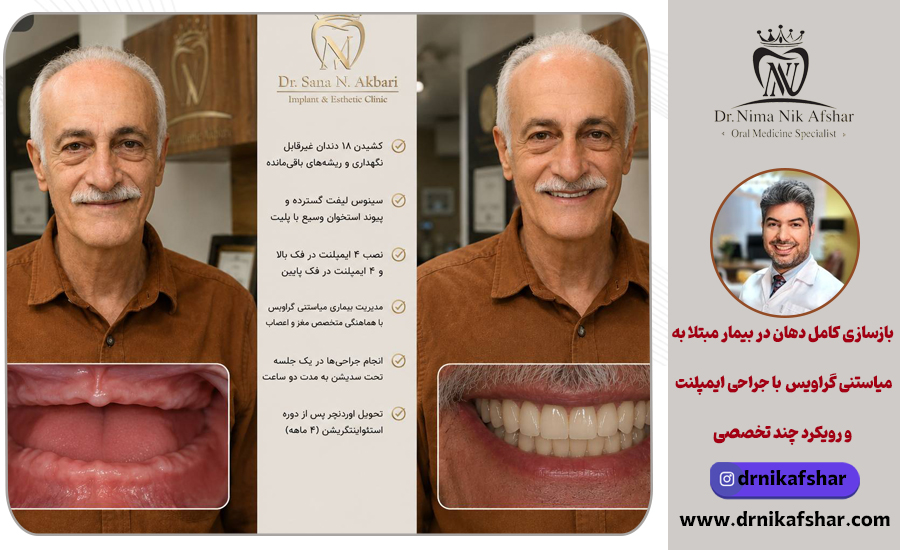 بازسازی کامل دهان در بیمار مبتلا به میاستنی گراویس با جراحی ایمپلنت و رویکرد چند تخصصی توسط دکتر نیما نیک افشار