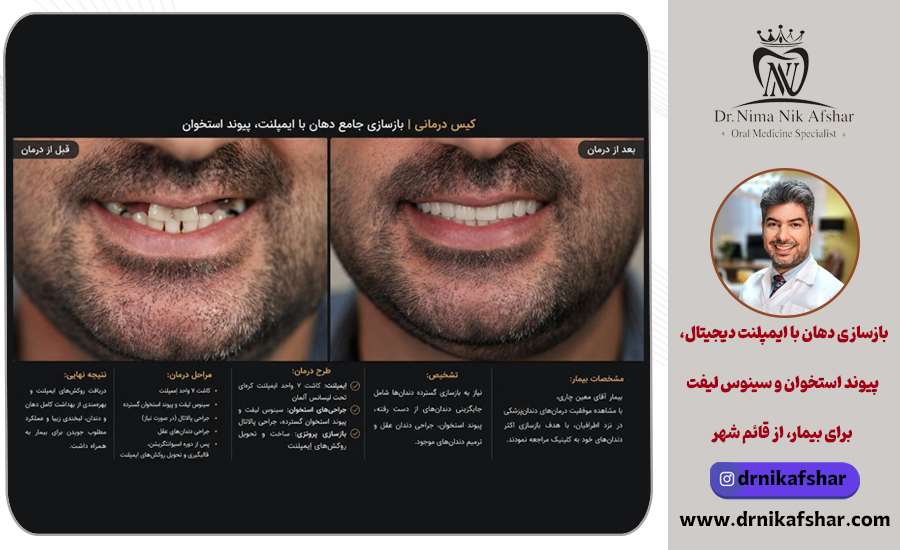 بازسازی دهان با ایمپلنت دیجیتال، پیوند استخوان و سینوس لیفت برای بیمار، از قائم شهر