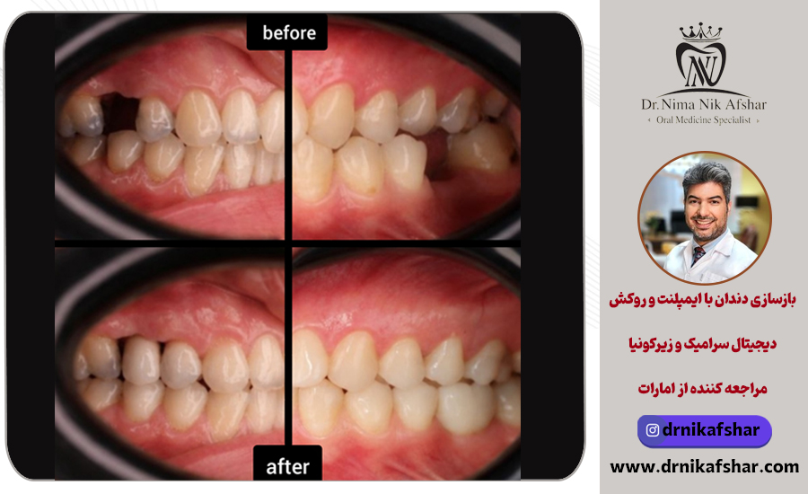 بازسازی دندان با ایمپلنت و روکش دیجیتال سرامیک و زیرکونیا مراجعه کننده از امارات