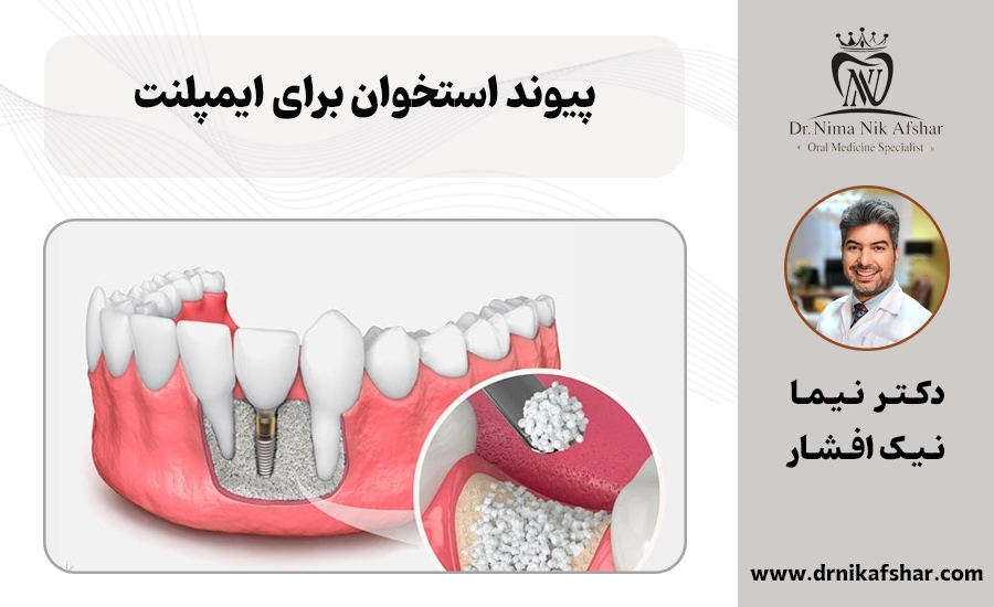 پیوند استخوان برای ایمپلنت