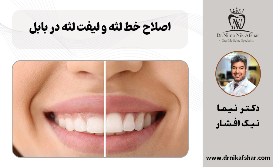 اصلاح خط لثه + هزینه لیفت لثه