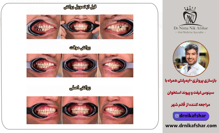 بازسازی پروتزی-ایمپلنتی همراه با سینوس لیفت و پیوند استخوان مراجعه کننده از قائم شهر